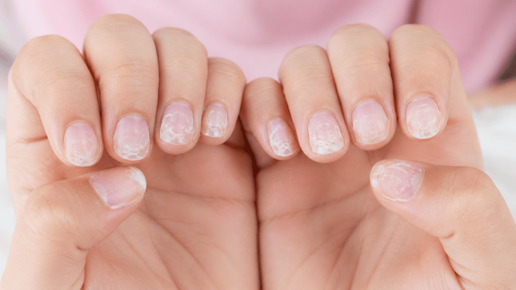 damaged nails after acrylic nails on kids