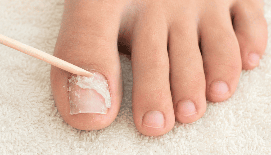 Gently removing softened acrylic from a natural toenail